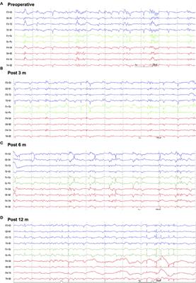 Case Report: Corpus Callosotomy in a Cat With Drug-Resistant Epilepsy of Unknown Cause